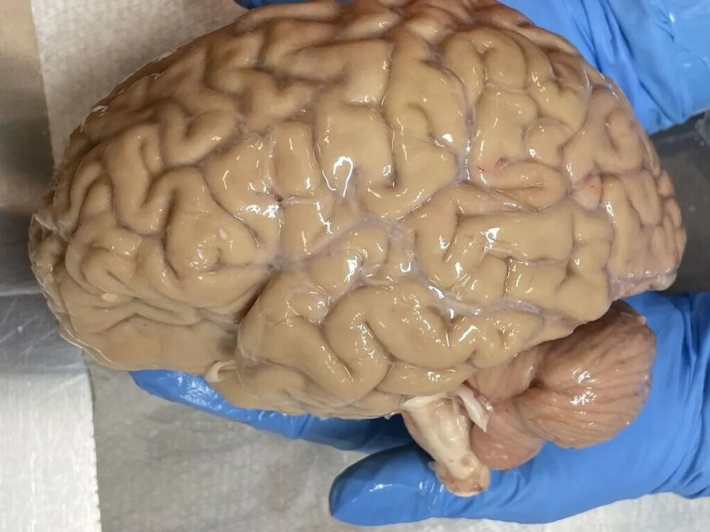 1 in 4 doctors say a frozen brain, body could be revived in the future