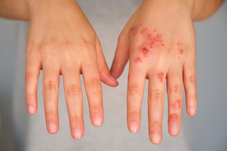 Apogee’s Royalty Deal With Blackstone Will Fund Pivotal Test in Eczema and More Apogee’s Royalty Deal With Blackstone Will Fund Pivotal Test in Eczema and More