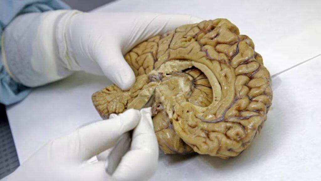 Blood test can detect early symptoms, 10 years before onset of Alzheimer’s | Health