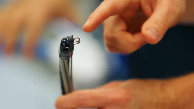 Edmonton hospital using medical technology to offer non-surgical weight loss procedure Edmonton hospital using medical technology to offer non-surgical weight loss procedure