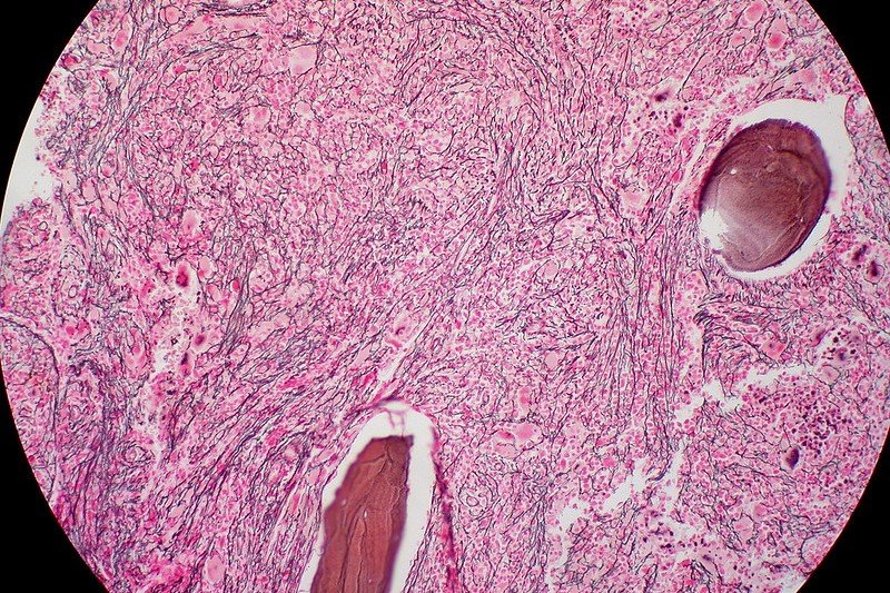 Lilly’s Newly Acquired Drug Shows Promise as Next-Gen Blood Cancer Med Lilly’s Newly Acquired Drug Shows Promise as Next-Gen Blood Cancer Med