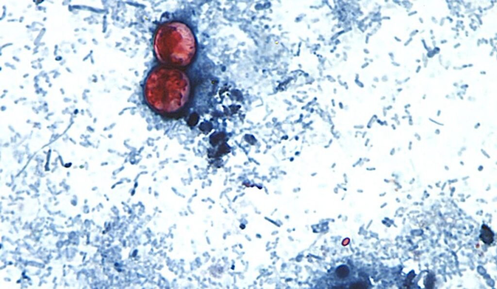 Outbreak of diarrhea-causing parasite grows to more than 1,000 cases