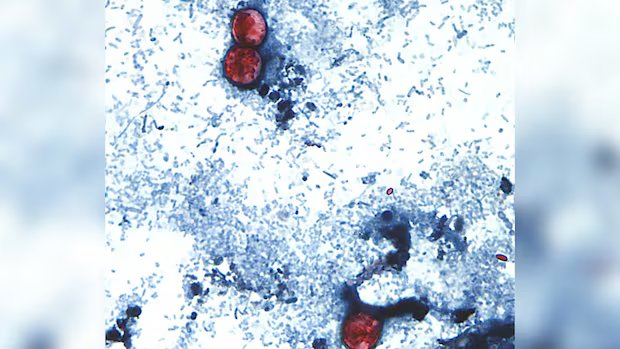 A diarrhea-causing parasite has infected more than 1,000 in the U.S. Is it in Canada? A diarrhea-causing parasite has infected more than 1,000 in the U.S. Is it in Canada?