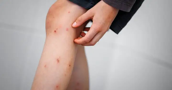 Edmonton kids experiencing ‘skeeter syndrome’ this wet, hot summer – Edmonton Edmonton kids experiencing ‘skeeter syndrome’ this wet, hot summer - Edmonton