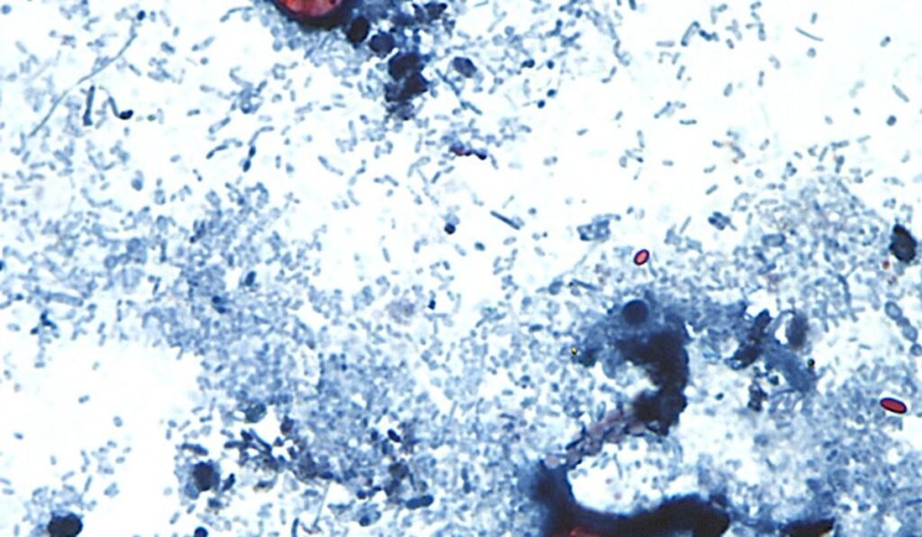 Outbreak of diarrhea-causing parasite grows to more than 1,000 cases Outbreak of diarrhea-causing parasite grows to more than 1,000 cases