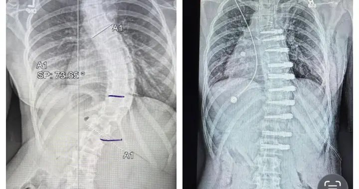 Alberta teen’s family sues government after nearly $200K out-of-country surgical bill Alberta teen’s family sues government after nearly $200K out-of-country surgical bill